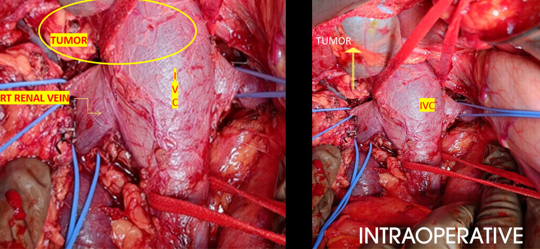 RETROPERITONEAL RETRO CAVAL TUMOR